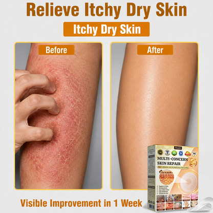🐝🔥𝐇𝐈𝐒𝐊𝐈𝐍® 𝐀𝐝𝐯𝐚𝐧𝐜𝐞𝐝 𝐁𝐞𝐞 𝐕𝐞𝐧𝐨𝐦 𝐍𝐚𝐧𝐨 𝐌𝐢𝐜𝐫𝐨𝐧𝐞𝐞𝐝𝐥𝐞 𝐒𝐤𝐢𝐧 𝐑𝐞𝐧𝐞𝐰𝐚𝐥 𝐏𝐚𝐭𝐜𝐡 — 𝐀𝐧𝐭𝐢-𝐚𝐠𝐢𝐧𝐠, 𝐇𝐲𝐝𝐫𝐚𝐭𝐢𝐧𝐠, 𝐒𝐤𝐢𝐧 𝐑𝐞𝐩𝐚𝐢𝐫, 𝐄𝐯𝐞𝐧 𝐓𝐨𝐧𝐞, 𝐀𝐜𝐧𝐞 𝐚𝐧𝐝 𝐃𝐚𝐫𝐤 𝐒𝐩𝐨𝐭 𝐓𝐫𝐞𝐚𝐭𝐦𝐞𝐧𝐭, 𝐖𝐚𝐫𝐭 𝐚𝐧𝐝 𝐌𝐨𝐥𝐞 𝐑𝐞𝐦𝐨𝐯𝐚𝐥, 𝐏𝐬𝐨𝐫𝐢𝐚𝐬𝐢𝐬 𝐑𝐞𝐥𝐢𝐞𝐟