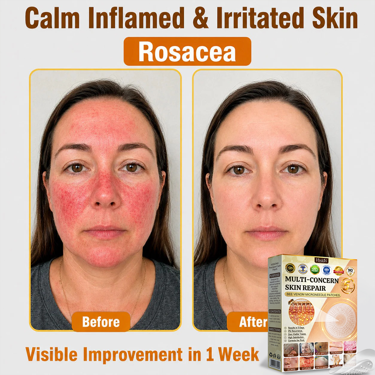 🐝🔥𝐇𝐈𝐒𝐊𝐈𝐍® 𝐀𝐝𝐯𝐚𝐧𝐜𝐞𝐝 𝐁𝐞𝐞 𝐕𝐞𝐧𝐨𝐦 𝐍𝐚𝐧𝐨 𝐌𝐢𝐜𝐫𝐨𝐧𝐞𝐞𝐝𝐥𝐞 𝐒𝐤𝐢𝐧 𝐑𝐞𝐧𝐞𝐰𝐚𝐥 𝐏𝐚𝐭𝐜𝐡 — 𝐀𝐧𝐭𝐢-𝐚𝐠𝐢𝐧𝐠, 𝐇𝐲𝐝𝐫𝐚𝐭𝐢𝐧𝐠, 𝐒𝐤𝐢𝐧 𝐑𝐞𝐩𝐚𝐢𝐫, 𝐄𝐯𝐞𝐧 𝐓𝐨𝐧𝐞, 𝐀𝐜𝐧𝐞 𝐚𝐧𝐝 𝐃𝐚𝐫𝐤 𝐒𝐩𝐨𝐭 𝐓𝐫𝐞𝐚𝐭𝐦𝐞𝐧𝐭, 𝐖𝐚𝐫𝐭 𝐚𝐧𝐝 𝐌𝐨𝐥𝐞 𝐑𝐞𝐦𝐨𝐯𝐚𝐥, 𝐏𝐬𝐨𝐫𝐢𝐚𝐬𝐢𝐬 𝐑𝐞𝐥𝐢𝐞𝐟
